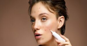 Ways To Keep Your Skin Free Of Acne Acne