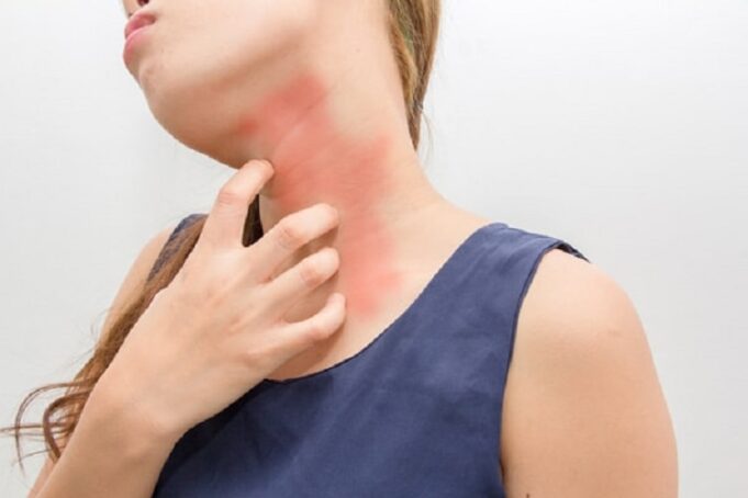 Allergies Allergies