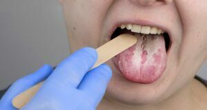 How to get rid of yeast infections? yeast infections