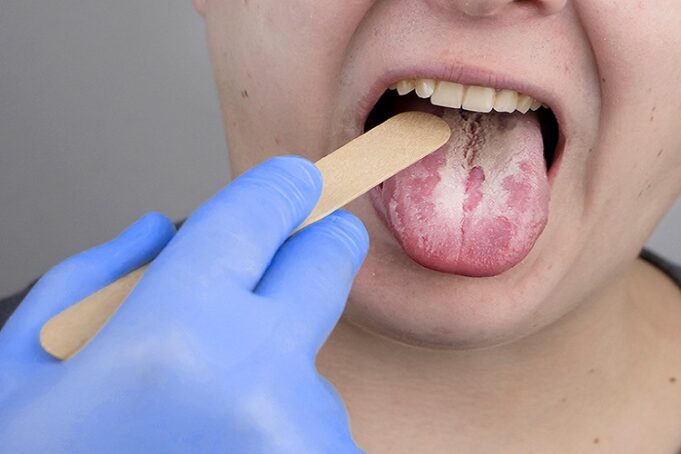 yeast infections yeast infections