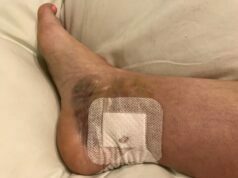 What Is The Relationship Between Ankle Discoloration And Vascular Health? Ankle Discoloration