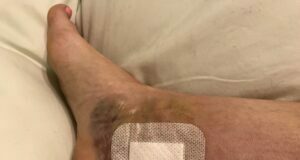 What Is The Relationship Between Ankle Discoloration And Vascular Health? Ankle Discoloration
