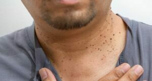 All You Need To Know About Skin Tags Skin Tags