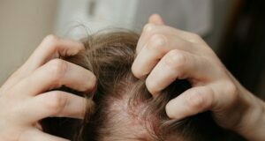 Top Home Remedies For Managing Scalp Psoriasis Scalp Psoriasis