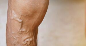 Common Risk Factors For Varicose Veins Varicose Veins