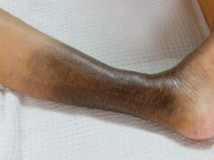 What Is Chronic Venous Insufficiency? Chronic Venous