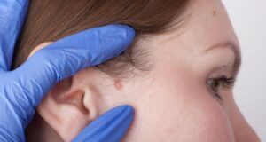 The Many Benefits Of Mohs Surgery For Skin Cancer Treatment Mohs Surgery