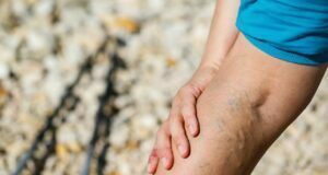 Varicose Veins; Causes And Treatments Varicose Veins