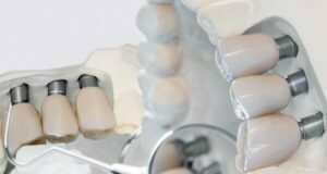 6 Reasons You Need Dental Implants Dental Implants