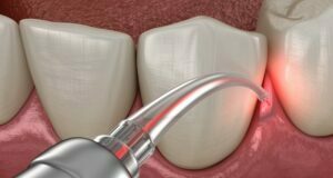6 Top Benefits Of Laser Dentistry Laser Dentistry