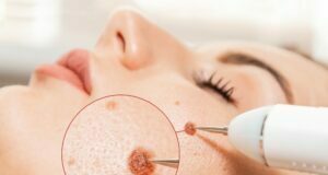 How To Remove Moles Using Surgical Intervention Moles
