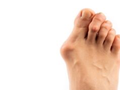 Bunion Treatment Queens NY And Its Facilities Healthy Feet
