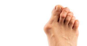 Bunion Treatment Queens NY And Its Facilities Healthy Feet